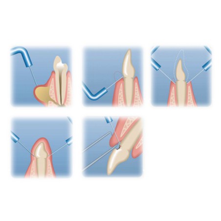 uso bisturi electrico satelec