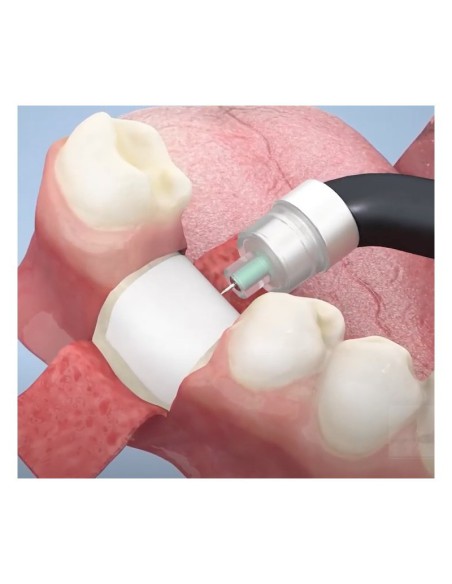 Fijador de Chinchetas Smartact Evo Cable 150 mm META