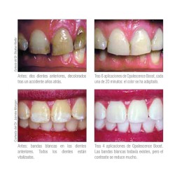 Opalescence PF Boost 40% Refill - Reposición x20 jeringas 2