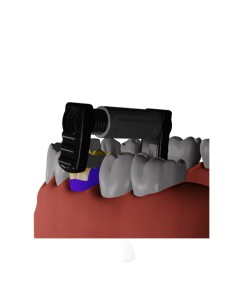 Fitstrio Kit Universal Contorneado y Acabado Interproximal Garrison 2