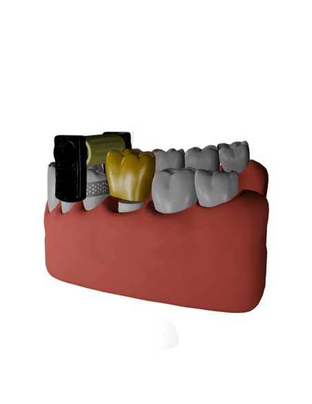 Fitstrio Kit Universal Contorneado y Acabado Interproximal Garrison