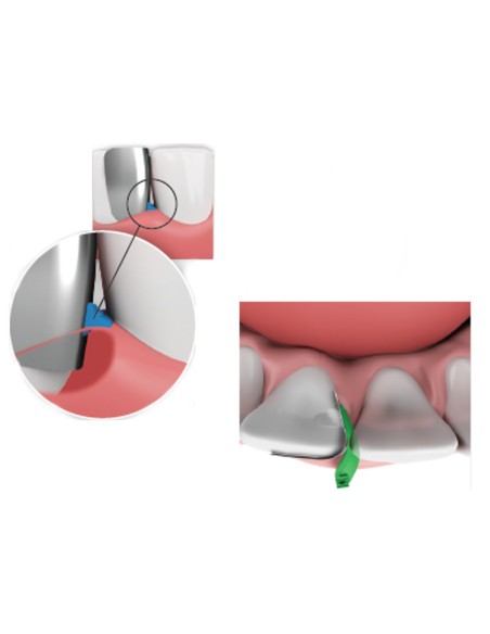 Fusion Sistema de Matrices Anteriores Kit Intro 200 piezas Garrison