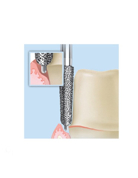 Fresa Diamante FG 6856P.314 Cónico, Bisel con Punta Guía, Clínica 5 uds Komet