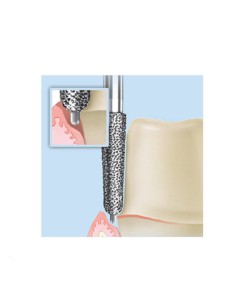 Fresa Diamante FG 8856P.314 Cónico, Bisel con Punta Guía, Fino, Clínica 5 uds Komet 2