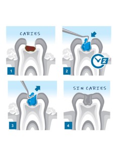 Brix 3000 Gel Enzimático Removedor de Caries Atramático Tubo 3ml. 2