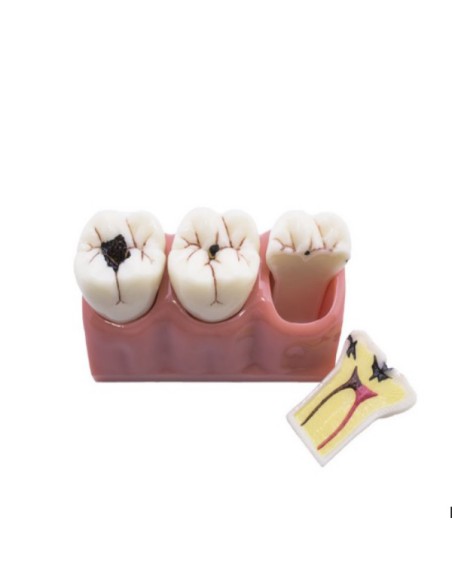 Modelo Caries Desmontables 3 Molares