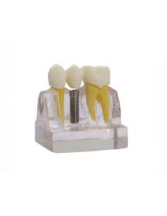 Modelo Demostración de Implantes
