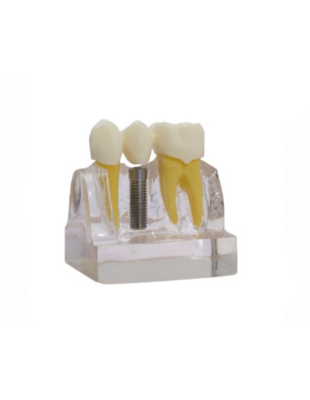 Modelo Demostración de Implantes