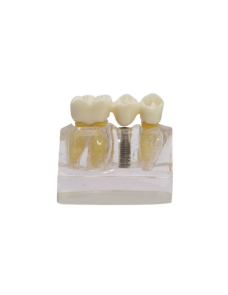 Modelo Demostración de Implantes