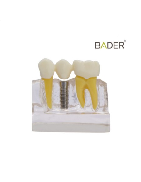 Modelo Demostración de Implantes