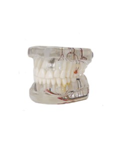Modelo Dental Transparente de Implante con Nervio