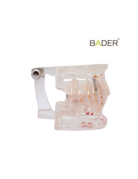 Modelo Dental Transparente de Implante 31 Dientes