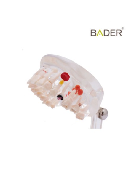 Modelo Dental Transparente Caries 32 Dientes