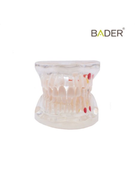 Modelo Dental Transparente Caries 32 Dientes