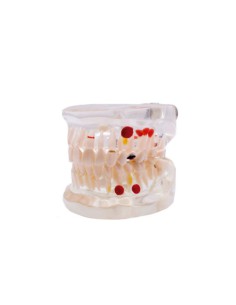 Modelo Dental Transparente Caries 32 Dientes