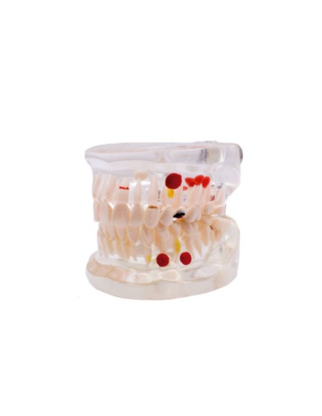 Modelo Dental Transparente Caries 32 Dientes